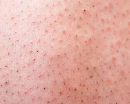 Jak pozbyć się kropek po goleniu i cieszyć się gładką skórą