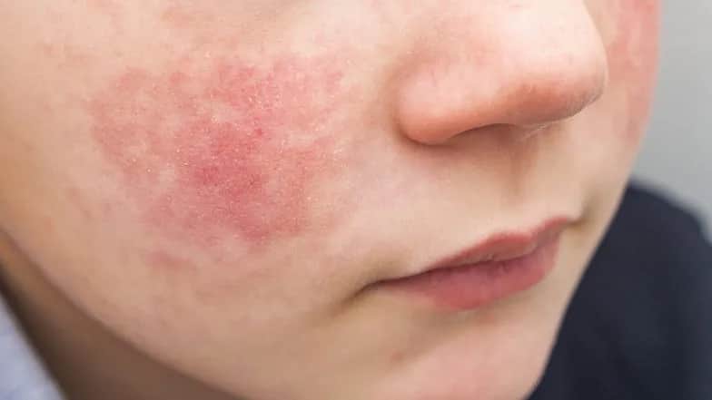 Jak skutecznie leczyć uczulenie na kosmetyki i uniknąć bólu skóry